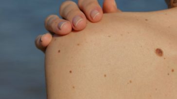Lunares buenos y malos en tu piel: aprende a distinguirlos